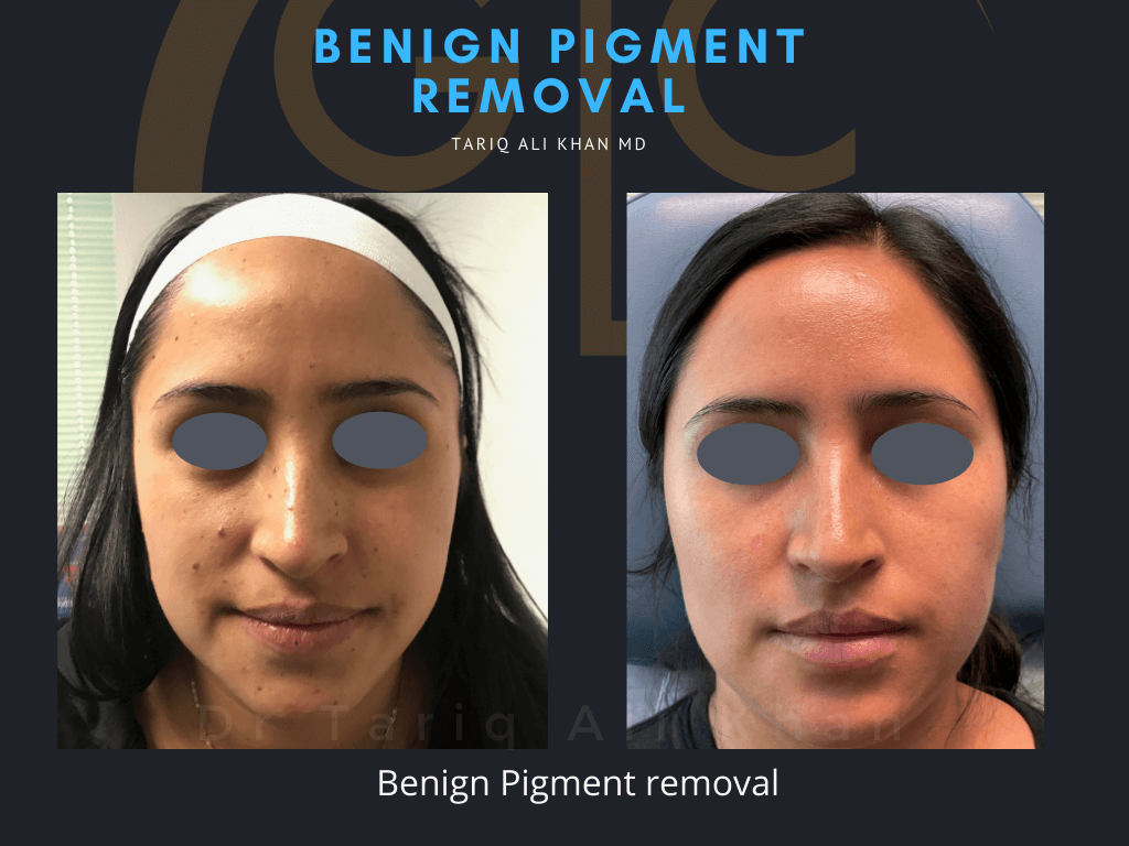 Gentle Care Laser Tustin & Long Beach Before and After picture - Mole Removal